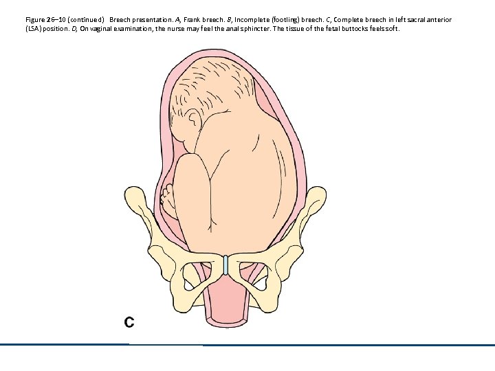 Figure 26– 10 (continued) Breech presentation. A, Frank breech. B, Incomplete (footling) breech. C,