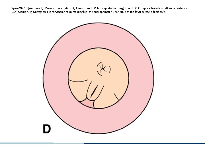 Figure 26– 10 (continued) Breech presentation. A, Frank breech. B, Incomplete (footling) breech. C,