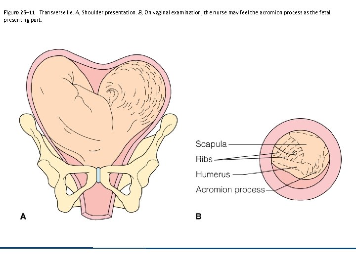 Figure 26– 11 Transverse lie. A, Shoulder presentation. B, On vaginal examination, the nurse