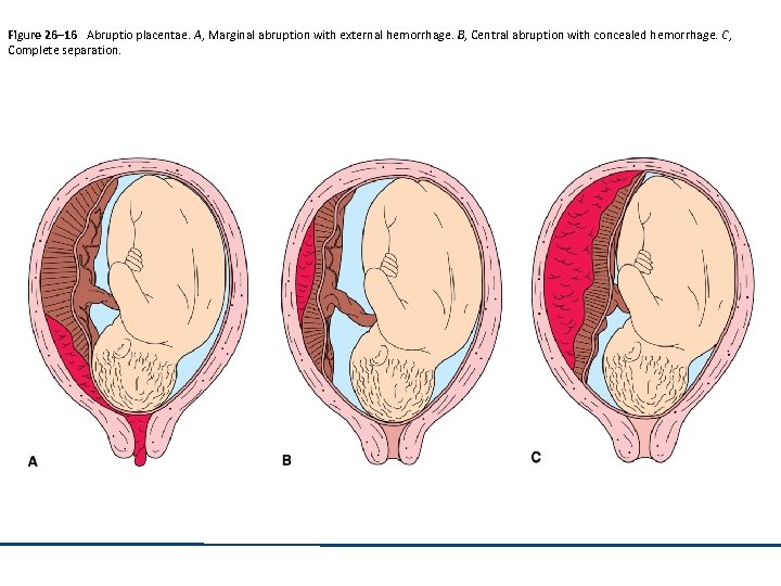 Figure 26– 16 Abruptio placentae. A, Marginal abruption with external hemorrhage. B, Central abruption