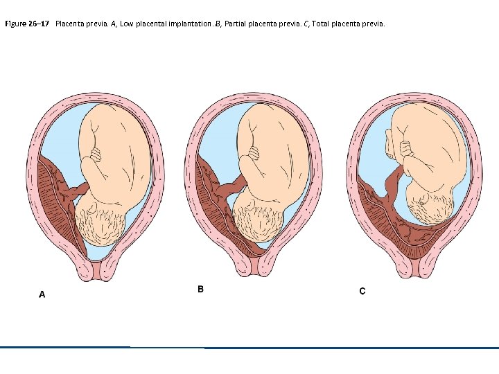 Figure 26– 17 Placenta previa. A, Low placental implantation. B, Partial placenta previa. C,