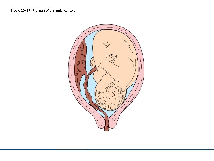 Figure 26– 19 Prolapse of the umbilical cord. 