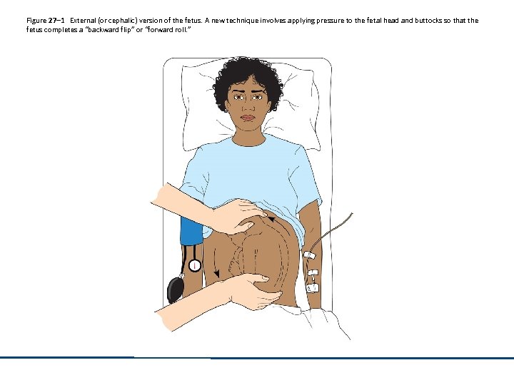 Figure 27– 1 External (or cephalic) version of the fetus. A new technique involves