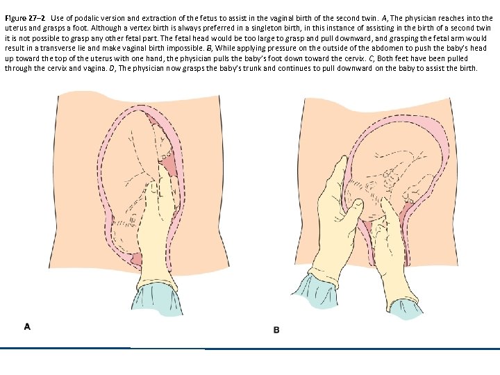 Figure 27– 2 Use of podalic version and extraction of the fetus to assist