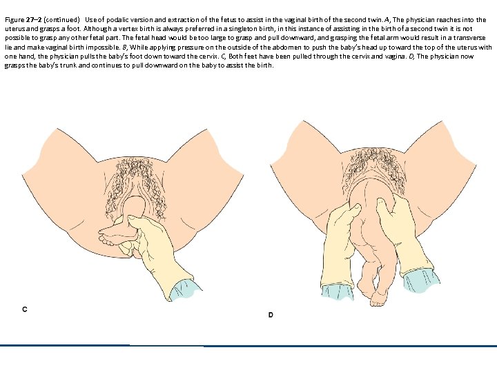 Figure 27– 2 (continued) Use of podalic version and extraction of the fetus to