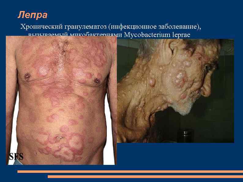 Лепра Хронический гранулематоз (инфекционное заболевание), вызываемый микобактериями Mycobacterium leprae Mycobacterium lepromatosis, протекающий с преимущественным