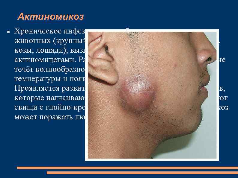 Актиномикоз Хроническое инфекционное заболевание человека и животных (крупный рогатый скот, реже — свиньи, овцы,