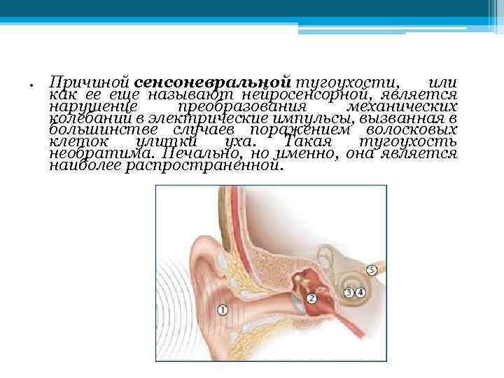 Сенсоневральная тугоухость картинки