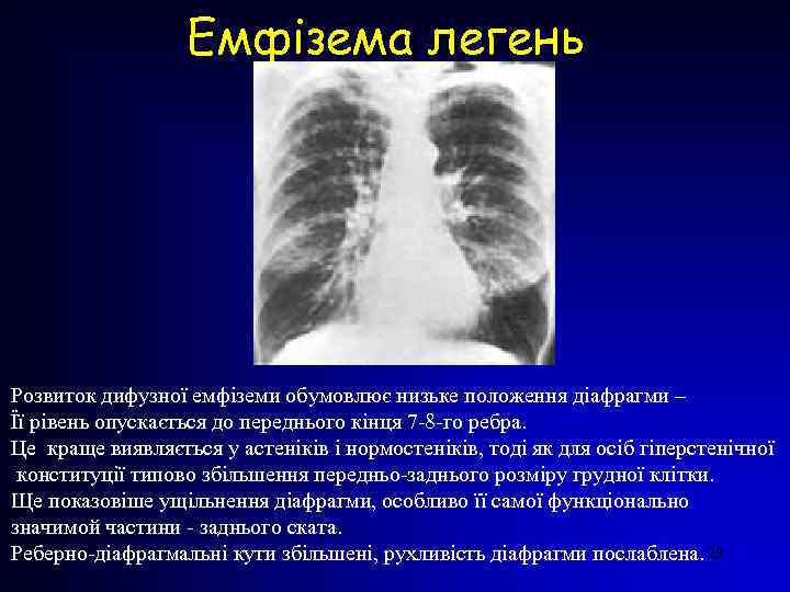 Емфізема легень Розвиток дифузної емфіземи обумовлює низьке положення діафрагми – Її рівень опускається до