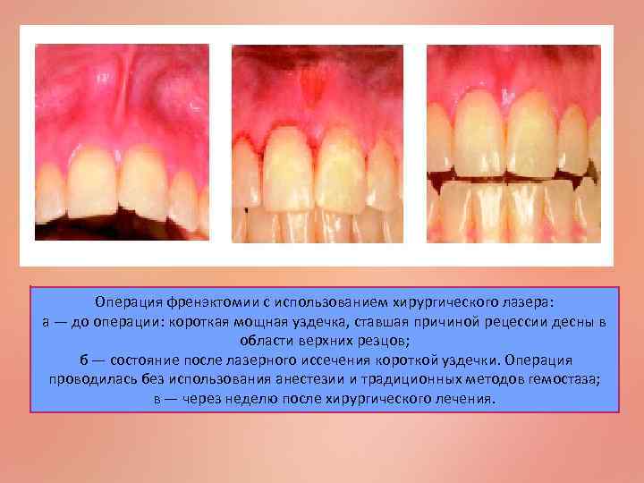 Операция френэктомии с использованием хирургического лазера: а — до операции: короткая мощная уздечка, ставшая
