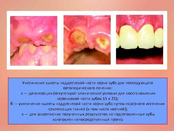 Увеличение высоты наддесневой части корня зуба для последующего ортопедического лечения: а — до операции