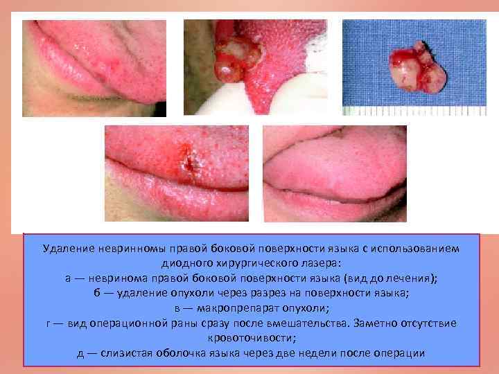 Удаление невринномы правой боковой поверхности языка с использованием диодного хирургического лазера: а — невринома