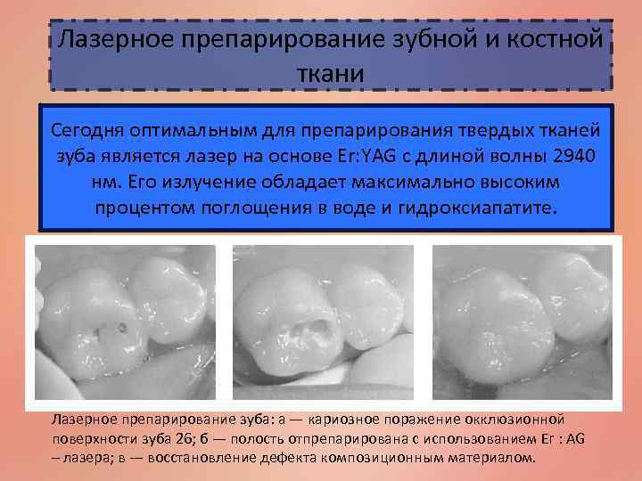 Лазерное препарирование зубной и костной ткани Сегодня оптимальным для препарирования твердых тканей зуба является