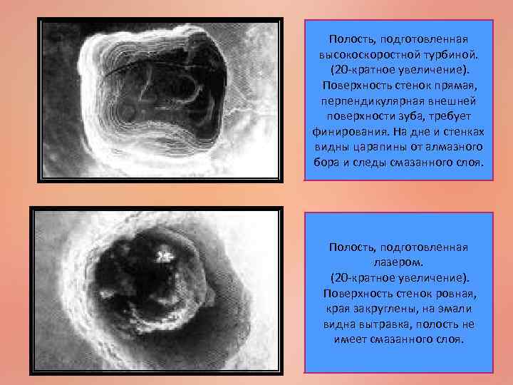 Полость, подготовленная высокоскоростной турбиной. (20 -кратное увеличение). Поверхность стенок прямая, перпендикулярная внешней поверхности зуба,