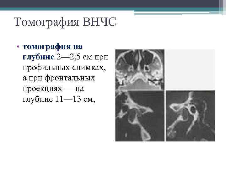 Томография ВНЧС • томография на глубине 2— 2, 5 см при профильных снимках, а