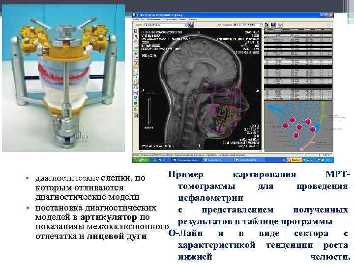 Пример картирования МРТтомограммы для проведения которым отливаются диагностические модели цефалометрии • постановка диагностических с