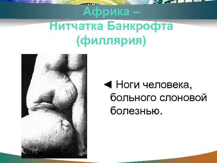 Африка – Нитчатка Банкрофта (филлярия) ◄ Ноги человека, больного слоновой болезнью. 