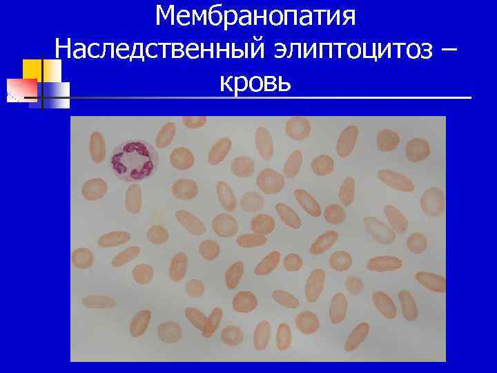 Мембранопатия Наследственный элиптоцитоз – кровь 