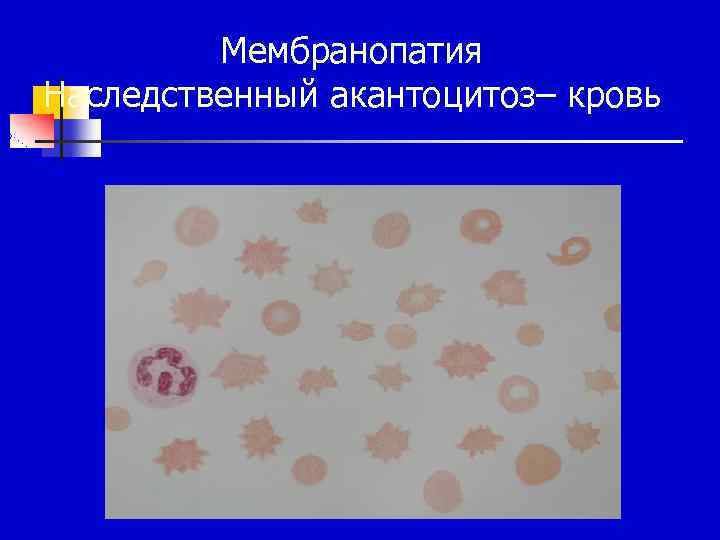 Мембранопатия Наследственный акантоцитоз– кровь 