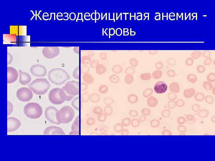 Железодефицитная анемия кровь 