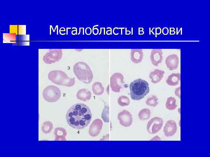 Мегалобласты в крови 