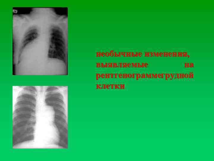 необычные изменения, выявляемые на рентгенограммегрудной клетки 
