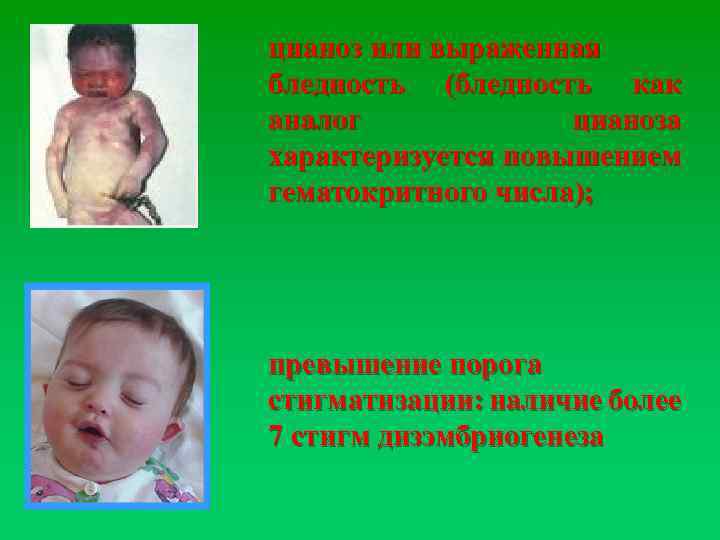 цианоз или выраженная бледность (бледность как аналог цианоза характеризуется повышением гематокритного числа); превышение порога