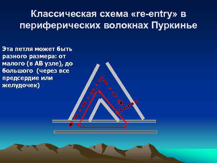 Классическая схема «re-entry» в периферических волокнах Пуркинье Эта петля может быть разного размера: от