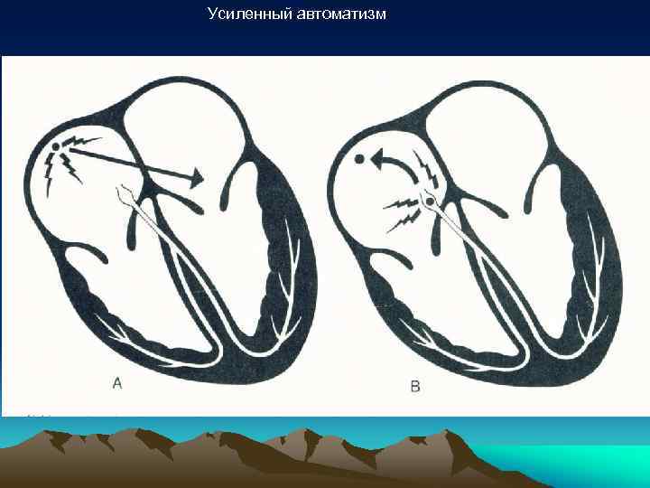 Усиленный автоматизм 