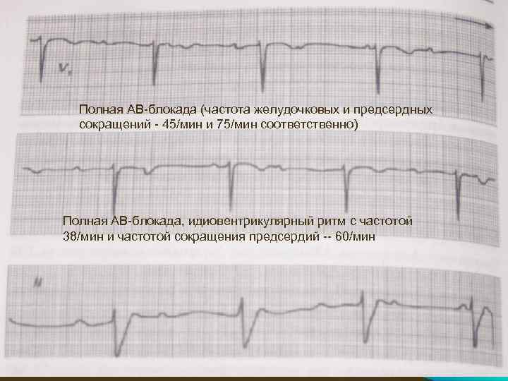 Полная АВ-блокада (частота желудочковых и предсердных сокращений - 45/мин и 75/мин соответственно) Полная АВ-блокада,