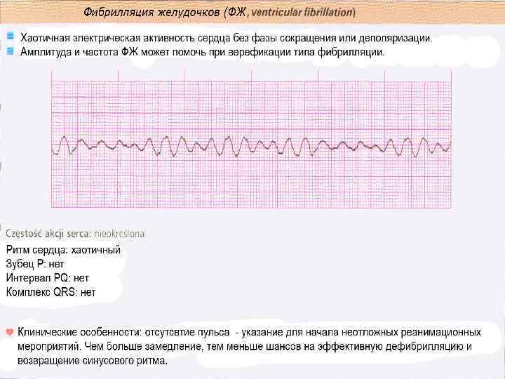 Тахикардия у ребенка