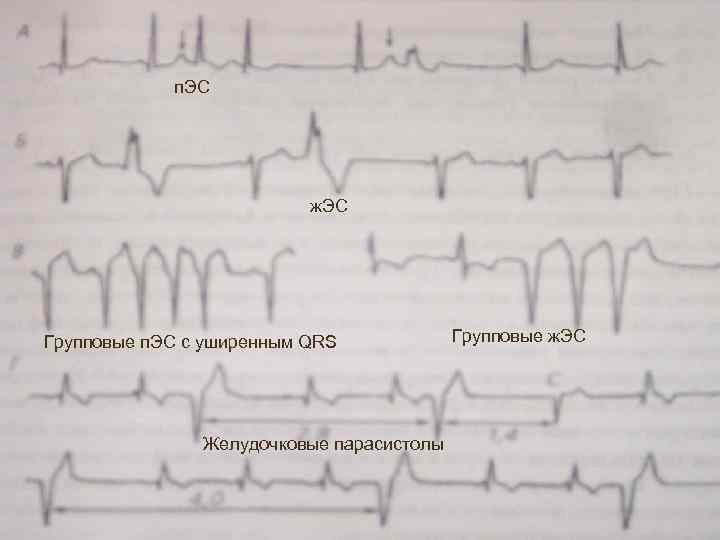 п. ЭС ж. ЭС Групповые п. ЭС с уширенным QRS Желудочковые парасистолы Групповые ж.