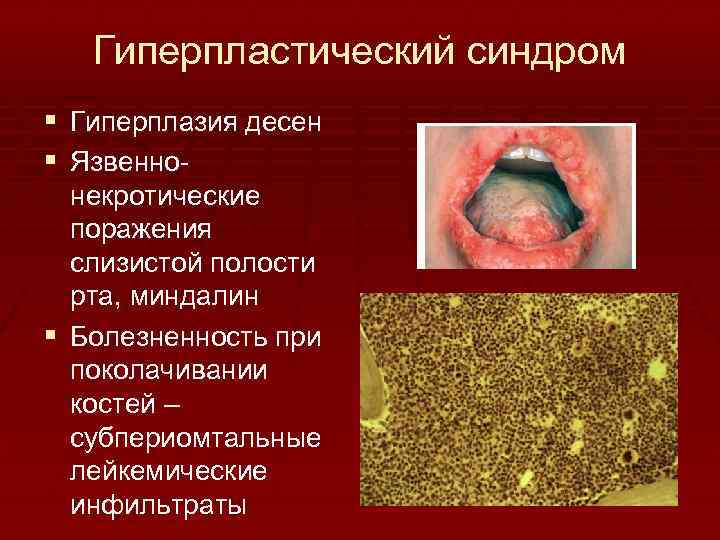 Гиперпластический синдром § Гиперплазия десен § Язвеннонекротические поражения слизистой полости рта, миндалин § Болезненность