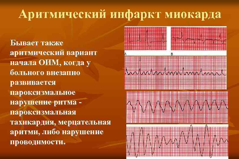Аритмический инфаркт миокарда Бывает также аритмический вариант начала ОИМ, когда у больного внезапно развивается