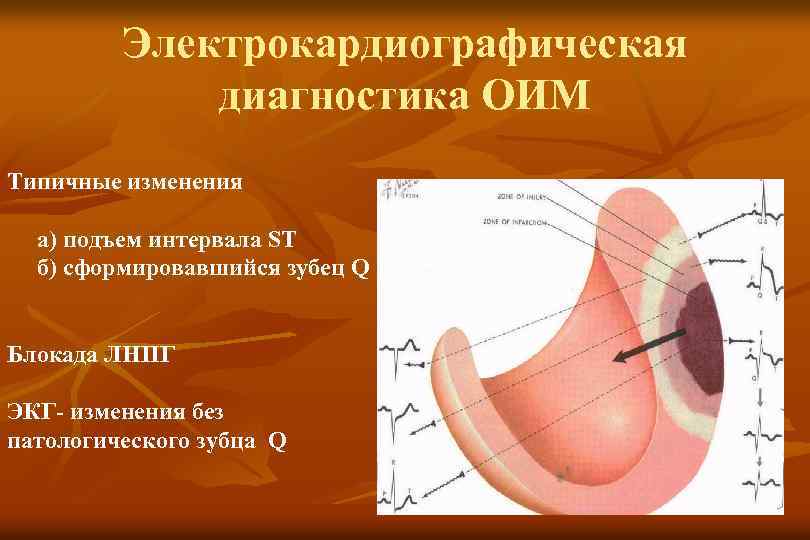 Электрокардиографическая диагностика ОИМ Типичные изменения а) подъем интервала ST б) сформировавшийся зубец Q Блокада