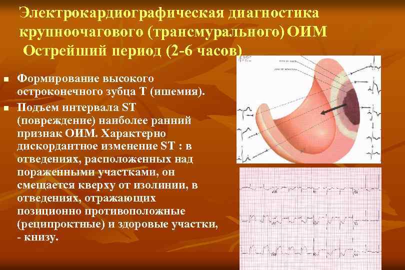 Электрокардиографическая диагностика крупноочагового (трансмурального) ОИМ Острейший период (2 -6 часов) n n Формирование высокого