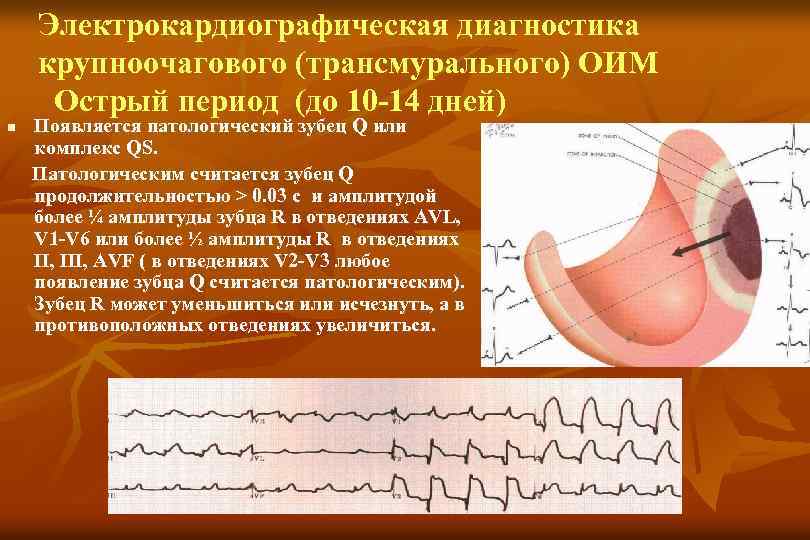 Электрокардиографическая диагностика крупноочагового (трансмурального) ОИМ Острый период (до 10 -14 дней) n Появляется патологический
