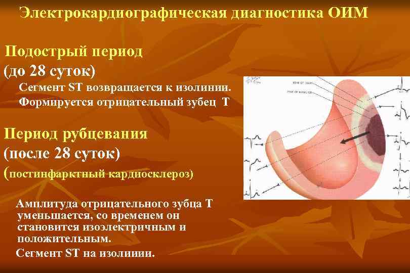 Электрокардиографическая диагностика ОИМ Подострый период (до 28 суток) Сегмент ST возвращается к изолинии. Формируется