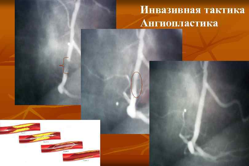 Инвазивная тактика Ангиопластика 