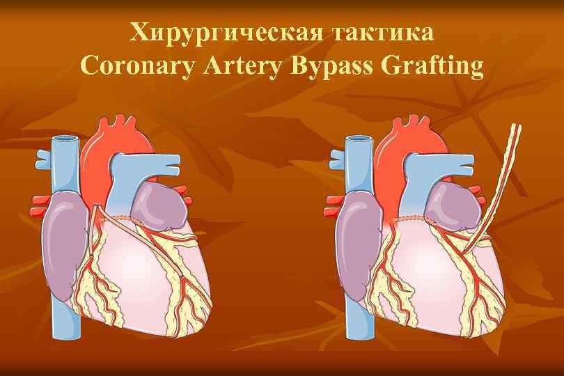 Хирургическая тактика Coronary Artery Bypass Grafting 