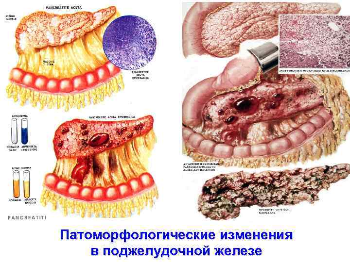 Патоморфологические изменения в поджелудочной железе 