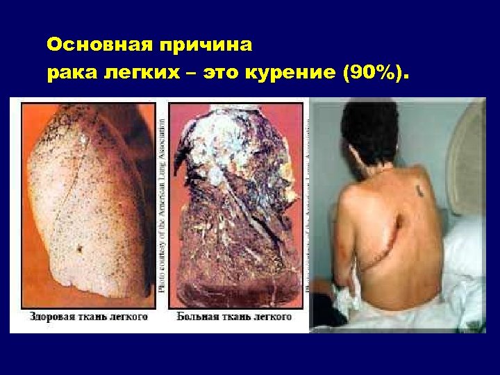 Основная причина рака легких – это курение (90%). 