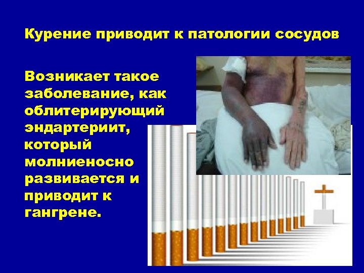 Курение приводит к патологии сосудов Возникает такое заболевание, как облитерирующий эндартериит, который молниеносно развивается