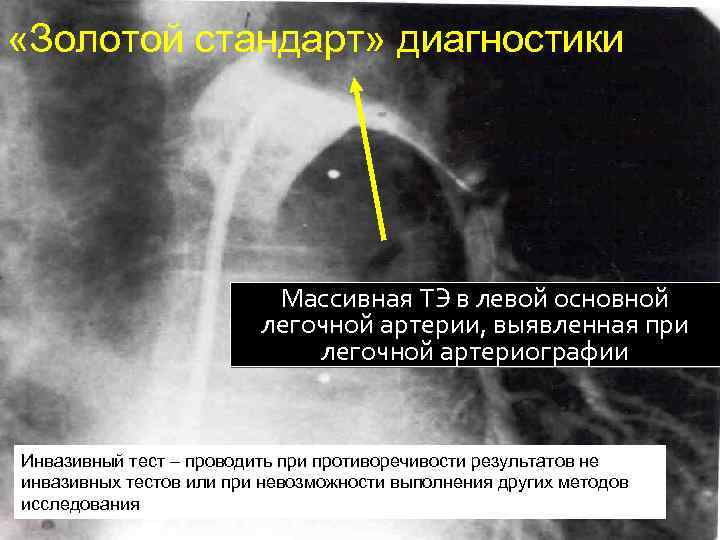  «Золотой стандарт» диагностики Массивная ТЭ в левой основной легочной артерии, выявленная при легочной