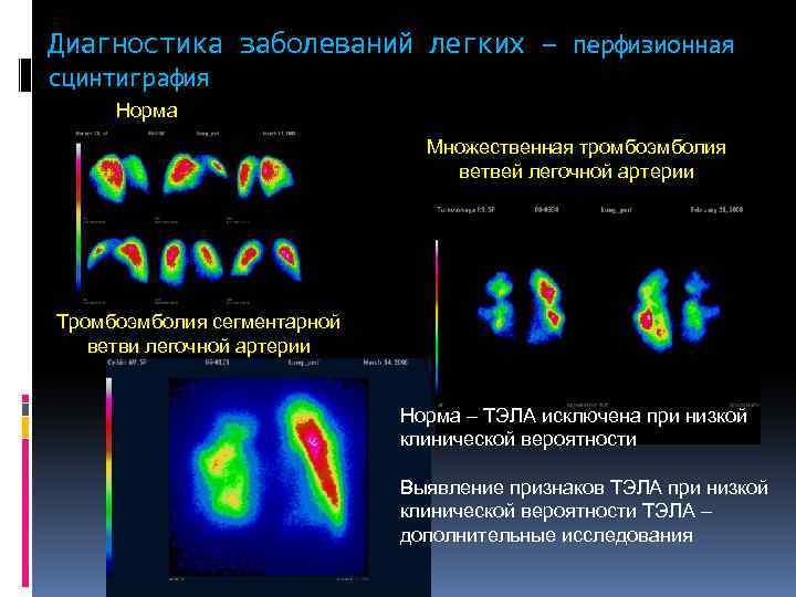 Диагностика заболеваний легких – перфизионная сцинтиграфия Норма Множественная тромбоэмболия ветвей легочной артерии Тромбоэмболия сегментарной