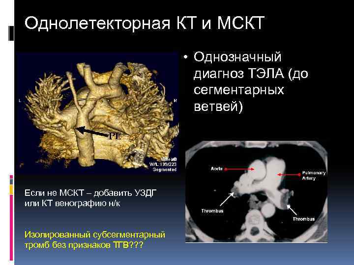 Однолетекторная КТ и МСКТ • Однозначный диагноз ТЭЛА (до сегментарных ветвей) Если не МСКТ