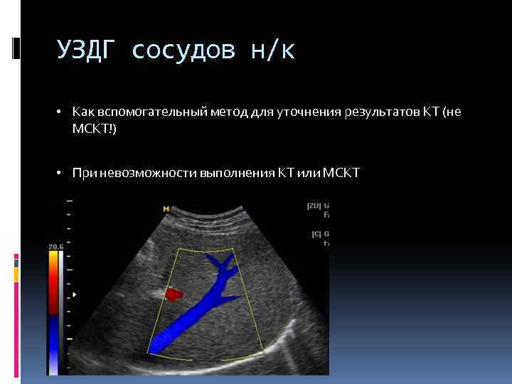 УЗДГ сосудов н/к • Как вспомогательный метод для уточнения результатов КТ (не МСКТ!) •
