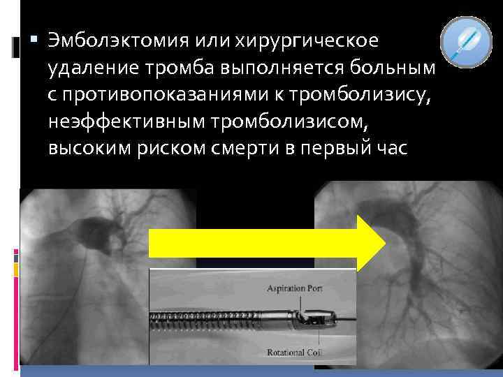  Эмболэктомия или хирургическое удаление тромба выполняется больным с противопоказаниями к тромболизису, неэффективным тромболизисом,