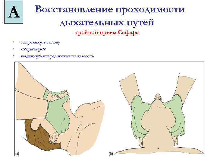 Восстановление проходимости. СЛР тройной прием Сафара. Приемы восстановления проходимости дыхательных путей. Алгоритм восстановления проходимости верхних дыхательных путей. Приемы восстановления проходимости дыхат путей.