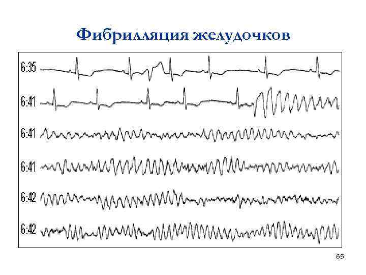 Фибрилляция желудочков 65 